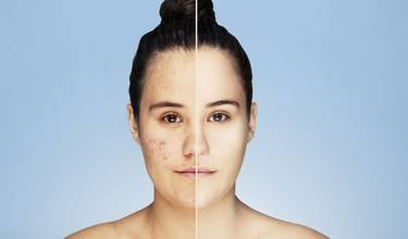 Akne hat einen anti-aging Effekt