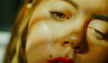 Hyperhidrosis – a sweaty mess