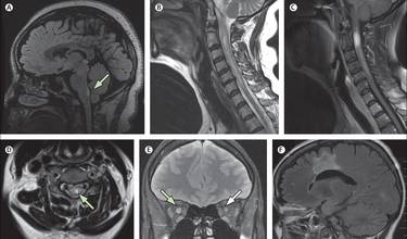 Neuromyelitis Optica (NMO)