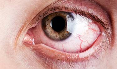 Sjogren’s syndrome
