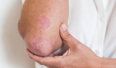 Forskningsdeltagere til psoriasis-forsøg