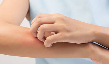 Klinische Studie zu Psoriasis sucht Teilnehmer